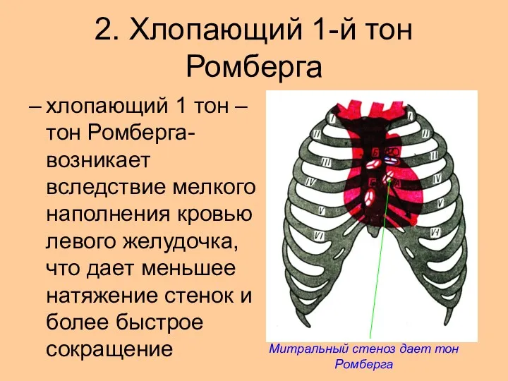 2. Хлопающий 1-й тон Ромберга хлопающий 1 тон – тон