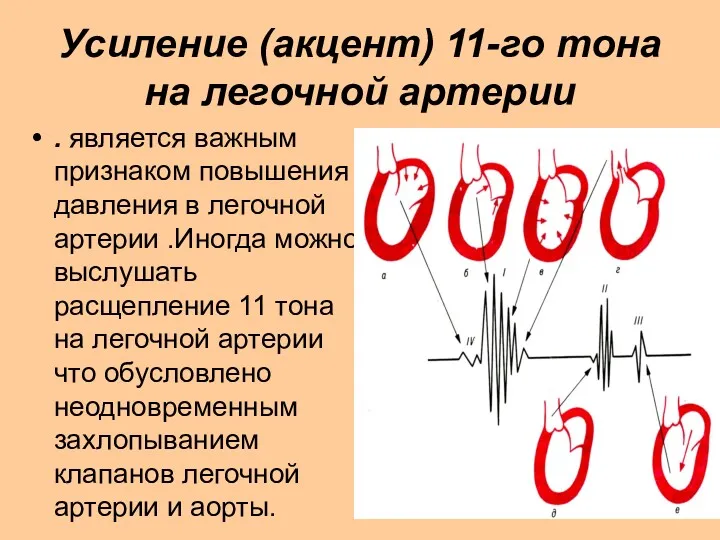 Усиление (акцент) 11-го тона на легочной артерии . является важным