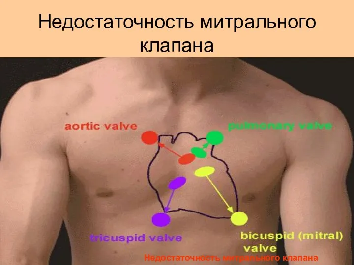 Недостаточность митрального клапана Недостаточность митрального клапана