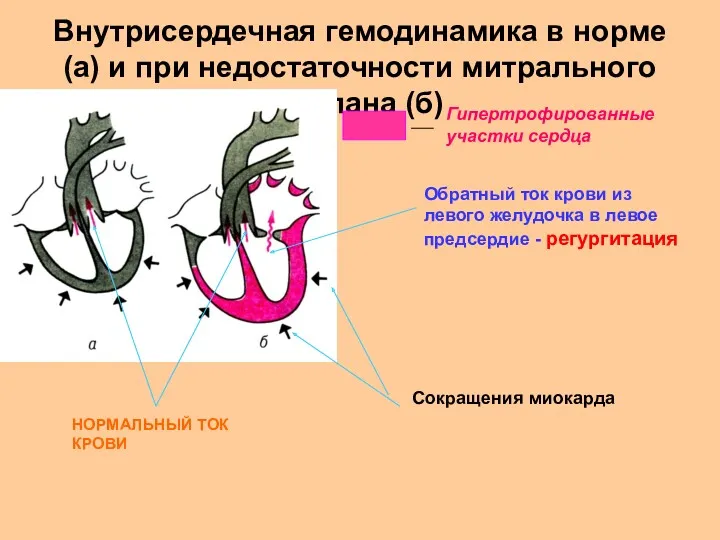 Внутрисердечная гемодинамика в норме (а) и при недостаточности митрального клапана