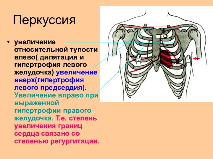 Перкуссия увеличение относительной тупости влево( дилятация и гипертрофия левого желудочка)