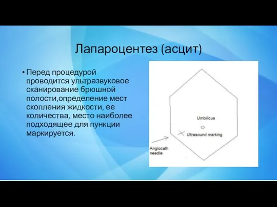 Лапароцентез (асцит) Перед процедурой проводится ультразвуковое сканирование брюшной полости,определение мест скопления жидкости, ее