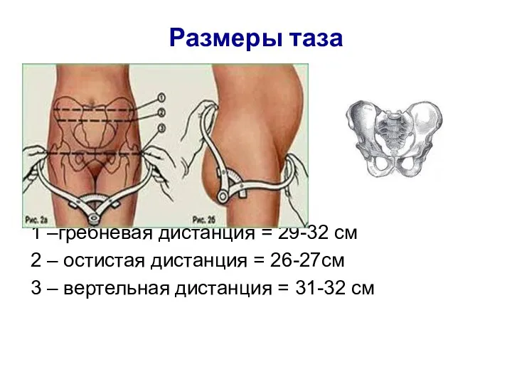 Размеры таза 1 –гребневая дистанция = 29-32 см 2 –