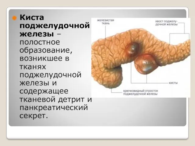 Киста поджелудочной железы – полостное образование, возникшее в тканях поджелудочной