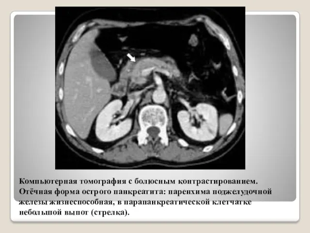 Компьютерная томография с болюсным контрастированием. Отёчная форма острого панкреатита: паренхима