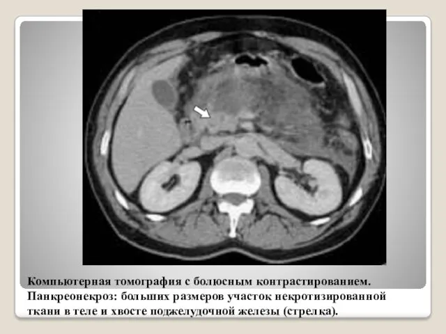 Компьютерная томография с болюсным контрастированием. Панкреонекроз: больших размеров участок некротизированной