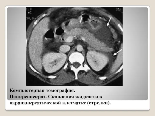 Компьютерная томография. Панкреонекроз. Скопления жидкости в парапанкреатической клетчатке (стрелки).