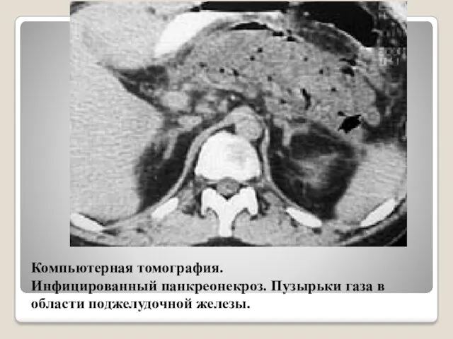 Компьютерная томография. Инфицированный панкреонекроз. Пузырьки газа в области поджелудочной железы.