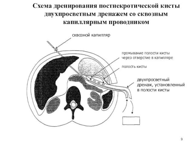 Схема дренирования постнекротической кисты двухпросветным дренажем со сквозным капиллярным проводником