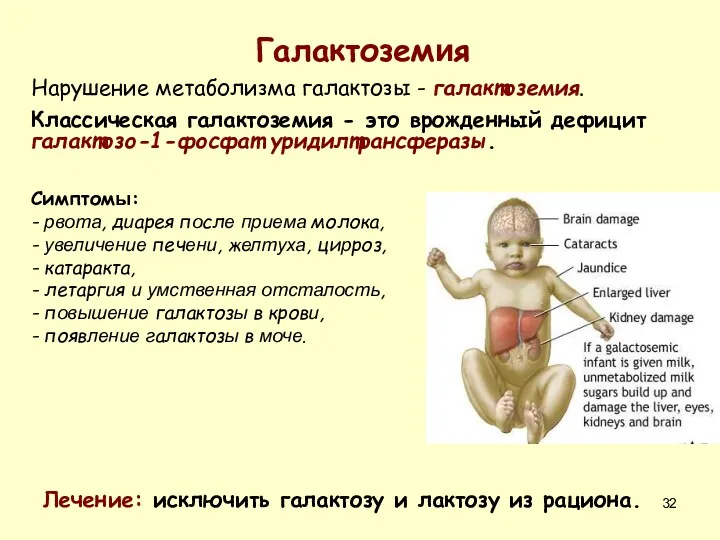 Галактоземия Нарушение метаболизма галактозы - галактоземия. Классическая галактоземия - это