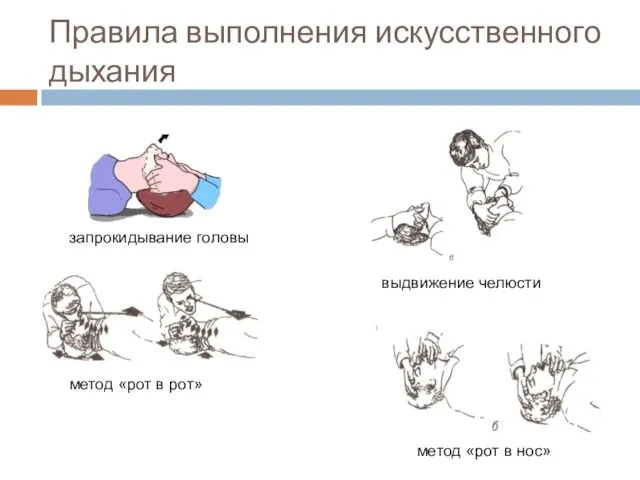 Правила выполнения искусственного дыхания метод «рот в рот» метод «рот в нос» запрокидывание головы выдвижение челюсти