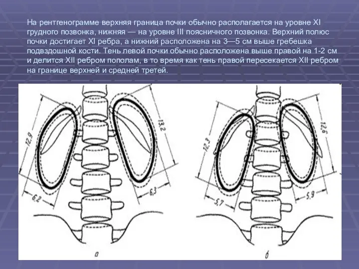 На рентгенограмме верхняя граница почки обычно располагается на уровне XI