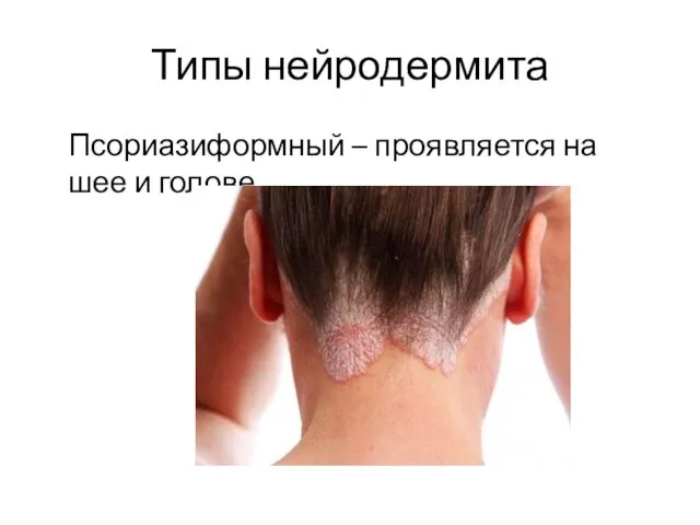 Типы нейродермита Псориазиформный – проявляется на шее и голове