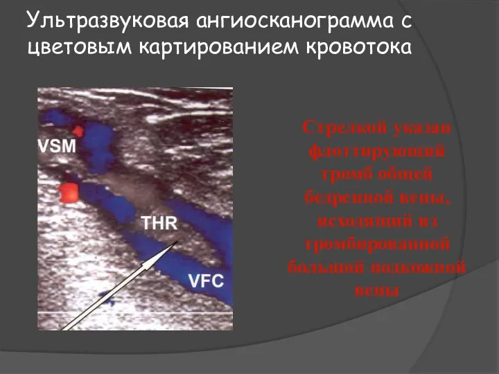 Ультразвуковая ангиосканограмма с цветовым картированием кровотока Стрелкой указан флоттирующий тромб