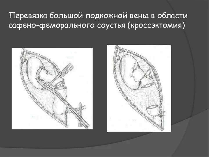 Перевязка большой подкожной вены в области сафено-феморального соустья (кроссэктомия)