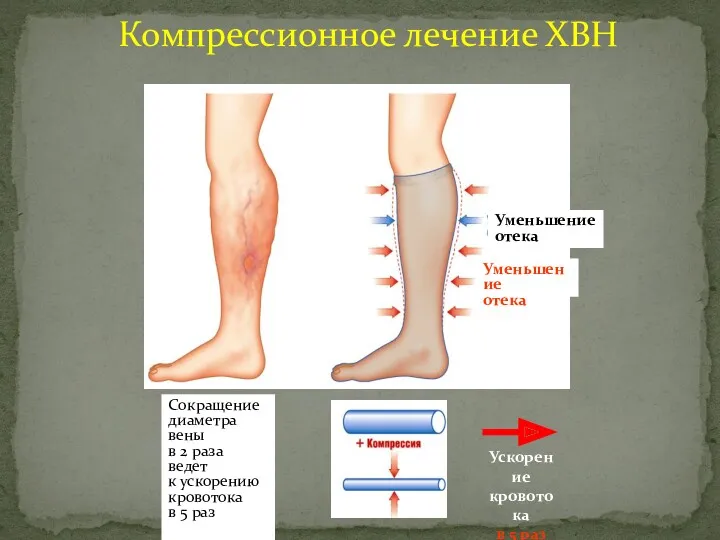 Компрессионное лечение ХВН Уменьшение отека Сокращение диаметра вены в 2