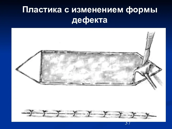 Пластика с изменением формы дефекта