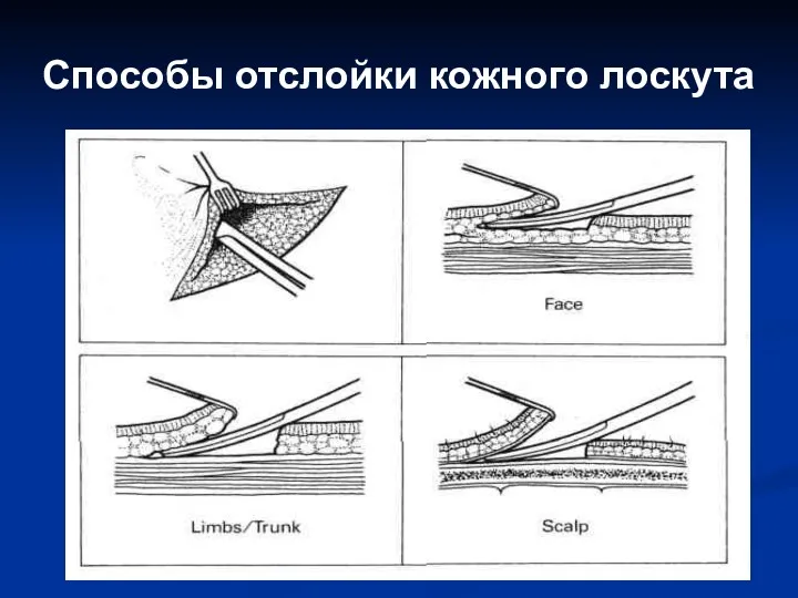 Способы отслойки кожного лоскута