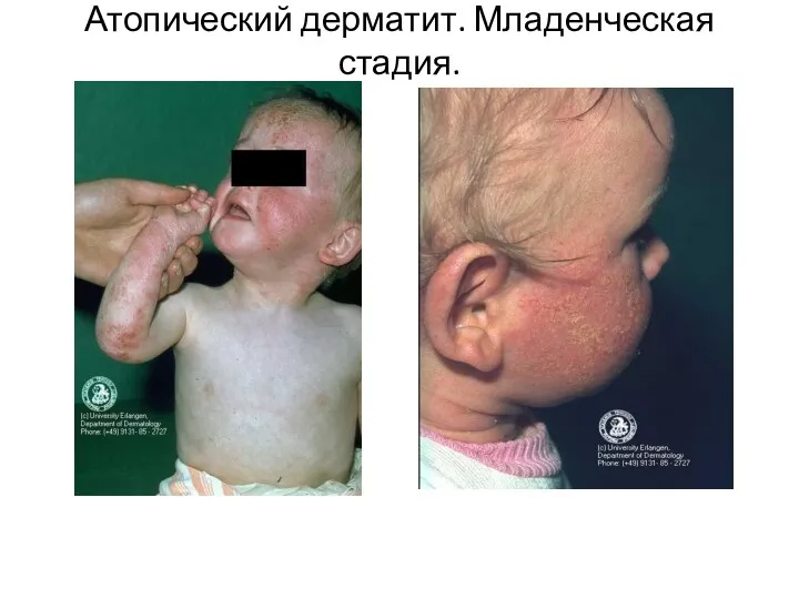 Атопический дерматит. Младенческая стадия.