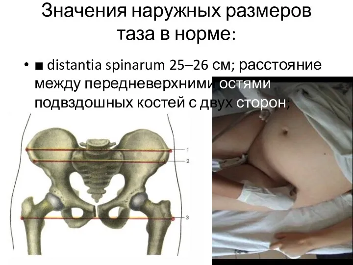 Значения наружных размеров таза в норме: ■ distantia spinarum 25–26 см; расстояние между