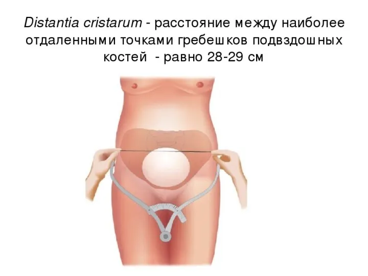 ■ distantia cristarum 28–29 см; расстояние между наиболее отдаленными участками гребней подвздошных костей