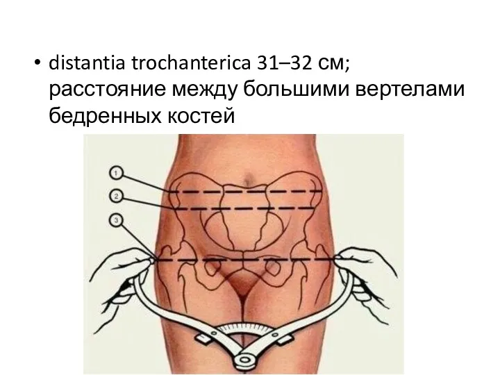 distantia trochanterica 31–32 см; расстояние между большими вертелами бедрен­ных костей