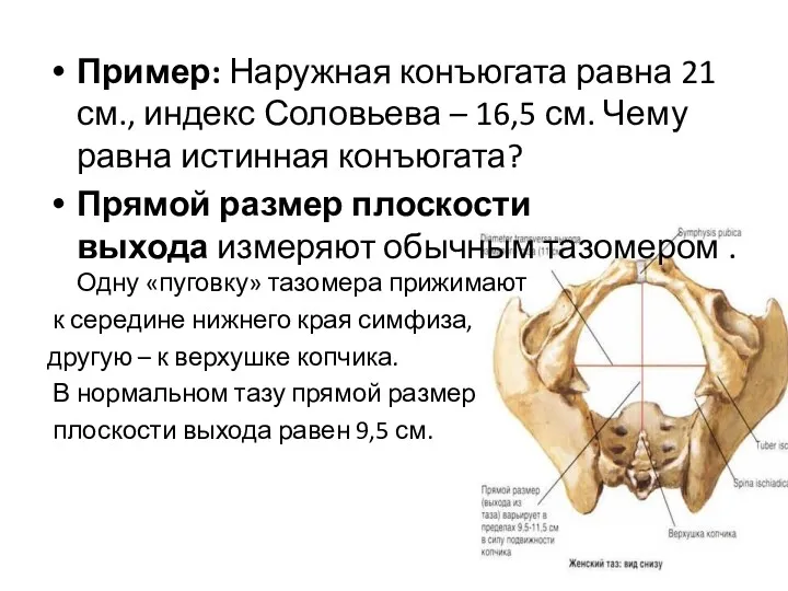 Пример: Наружная конъюгата равна 21 см., индекс Соловьева – 16,5 см. Чему равна