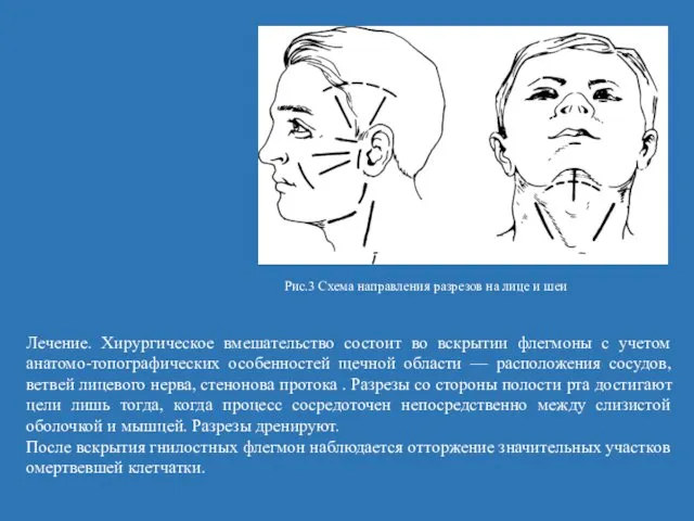 Лечение. Хирургическое вмешательство состоит во вскрытии флегмоны с учетом анатомо-топографических