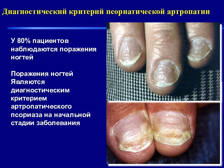 У 80% пациентов наблюдаются поражения ногтей Поражения ногтей Являются диагностическим