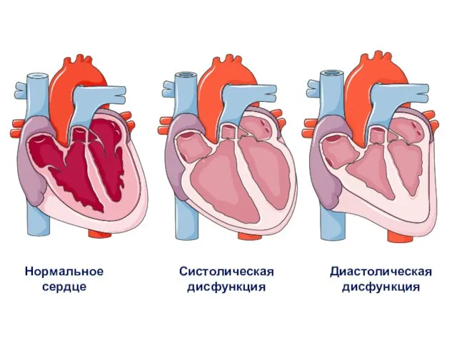 Нормальное сердце Систолическая дисфункция Диастолическая дисфункция