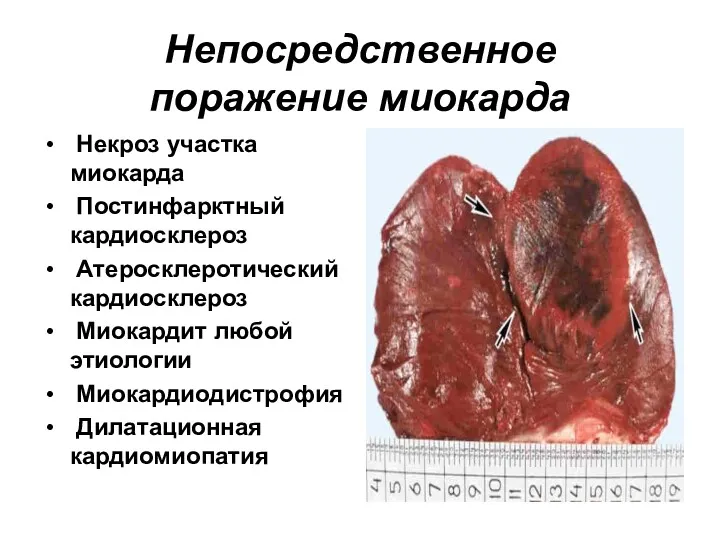 Непосредственное поражение миокарда Некроз участка миокарда Постинфарктный кардиосклероз Атеросклеротический кардиосклероз Миокардит любой этиологии Миокардиодистрофия Дилатационная кардиомиопатия