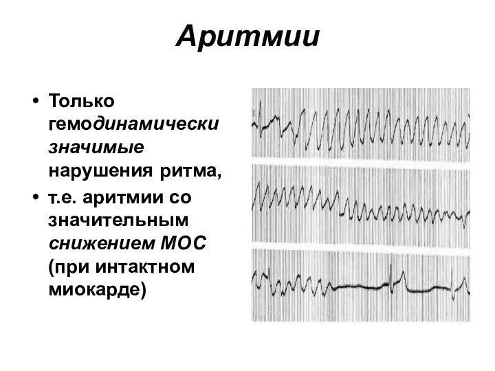 Аритмии Только гемодинамически значимые нарушения ритма, т.е. аритмии со значительным снижением МОС (при интактном миокарде)