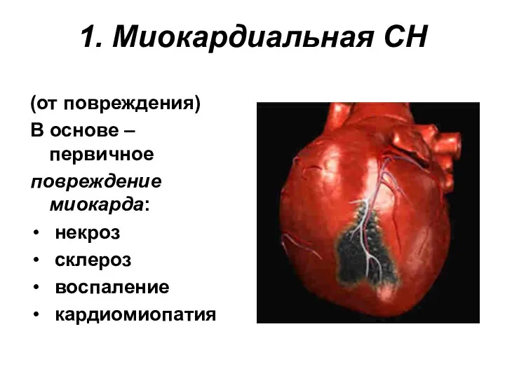 1. Миокардиальная СН (от повреждения) В основе – первичное повреждение миокарда: некроз склероз воспаление кардиомиопатия