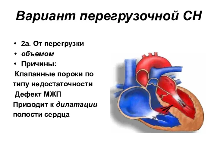 Вариант перегрузочной СН 2а. От перегрузки объемом Причины: Клапанные пороки