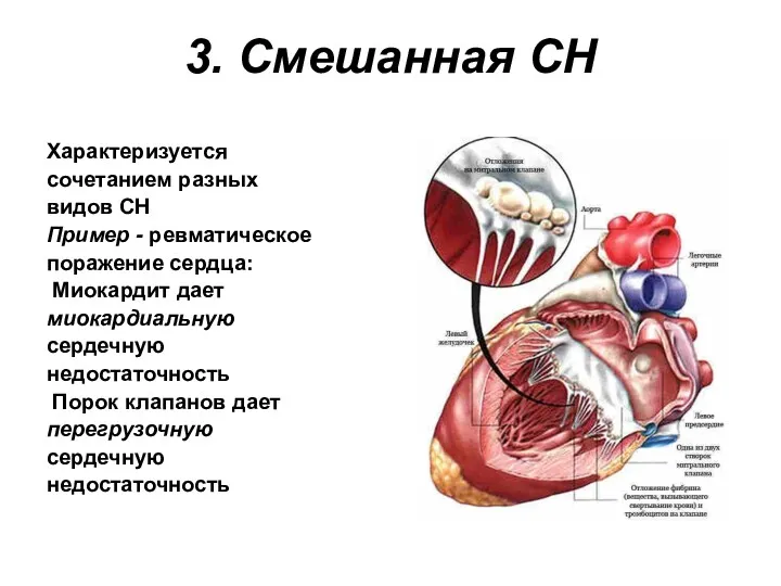 3. Смешанная СН Характеризуется сочетанием разных видов СН Пример -