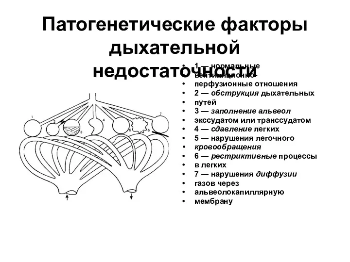 Патогенетические факторы дыхательной недостаточности 1 — нормальные вентиляционно- перфузионные отношения