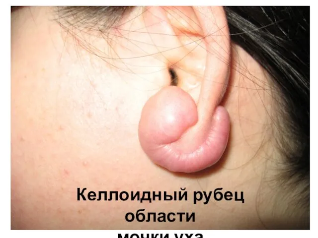 Келлоидный рубец области мочки уха