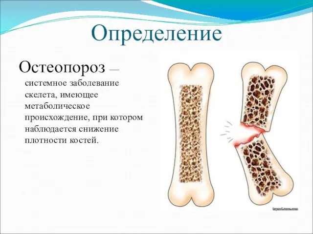Определение Остеопороз — системное заболевание скелета, имеющее метаболическое происхождение, при котором наблюдается снижение плотности костей.
