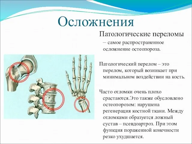 Осложнения Патологические переломы – самое распространенное осложнение остеопороза. Патологический перелом