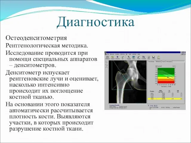 Диагностика Остеоденситометрия Рентгенологическая методика. Исследование проводится при помощи специальных аппаратов