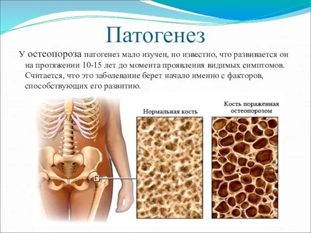 Патогенез У остеопороза патогенез мало изучен, но известно, что развивается