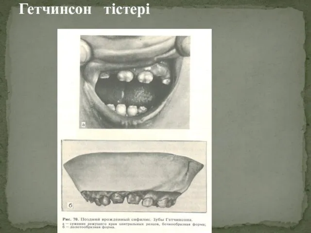 Гетчинсон тістері