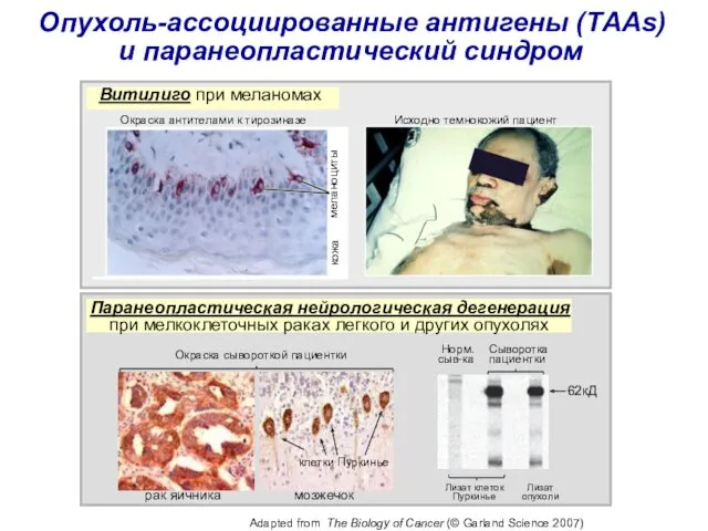 Опухоль-ассоциированные антигены (TАAs) и паранеопластический синдром рак яичника мозжечок клетки