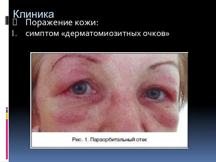 Клиника Поражение кожи: симптом «дерматомиозитных очков»
