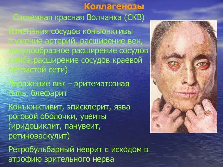 Коллагенозы Системная красная Волчанка (СКВ) Изменения сосудов конъюнктивы (сужение артерий,