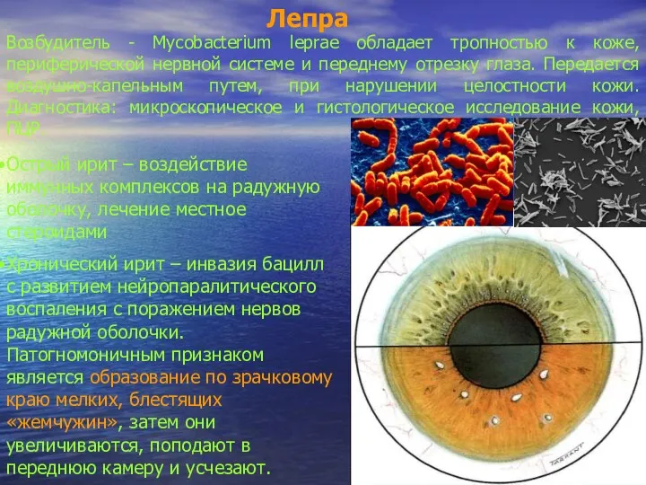 Лепра Возбудитель - Mycobacterium leprae обладает тропностью к коже, периферической
