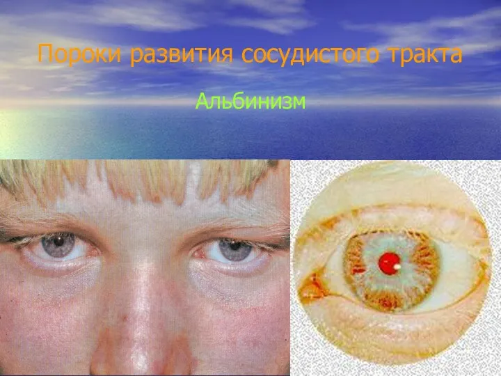 Альбинизм Пороки развития сосудистого тракта