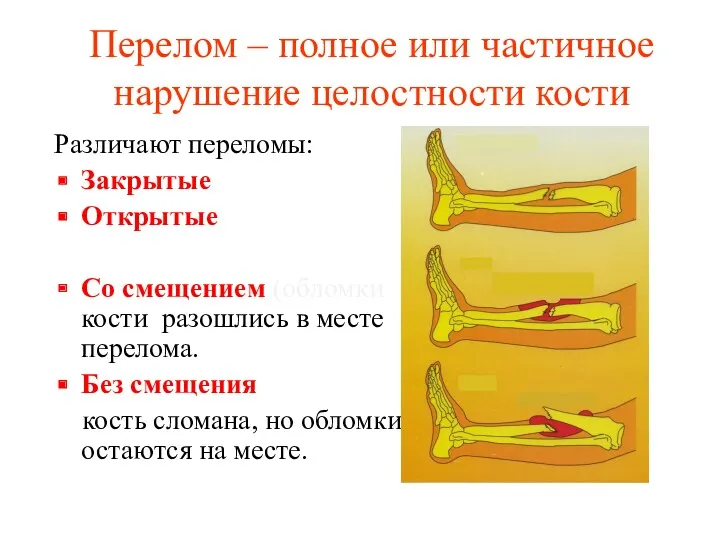 Перелом – полное или частичное нарушение целостности кости Различают переломы: