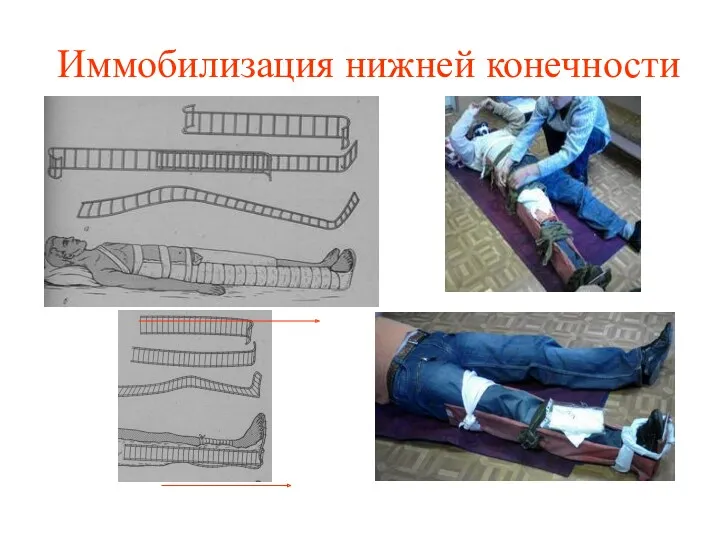 Иммобилизация нижней конечности