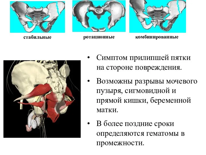 стабильные ротационные комбинированные Симптом прилипшей пятки на стороне повреждения. Возможны